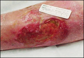 Ulcer venos (ulcer cronic, ulcer varicos)